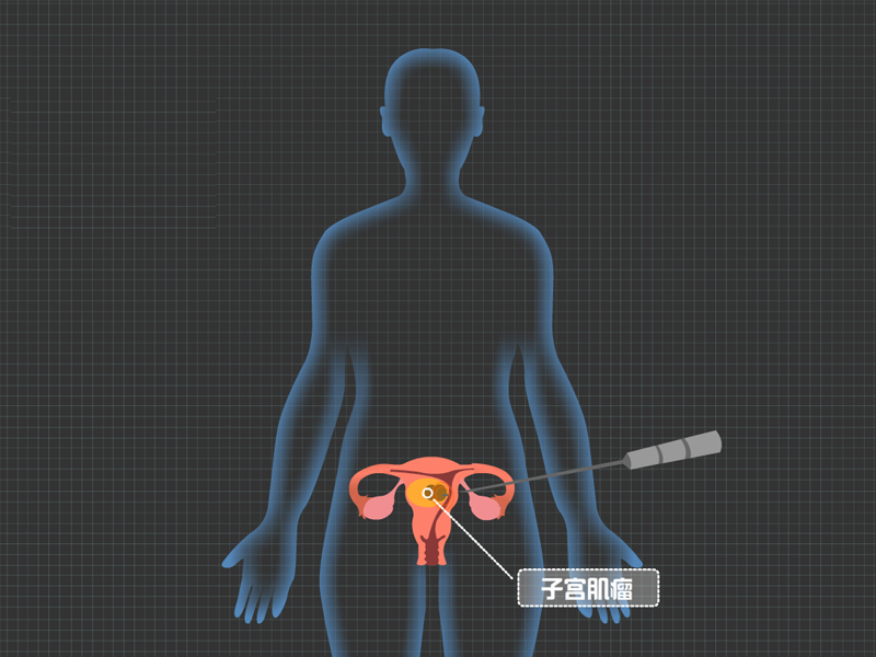 子宫肌瘤手术会影响生育？一根细针“烧”死肌瘤护子宫